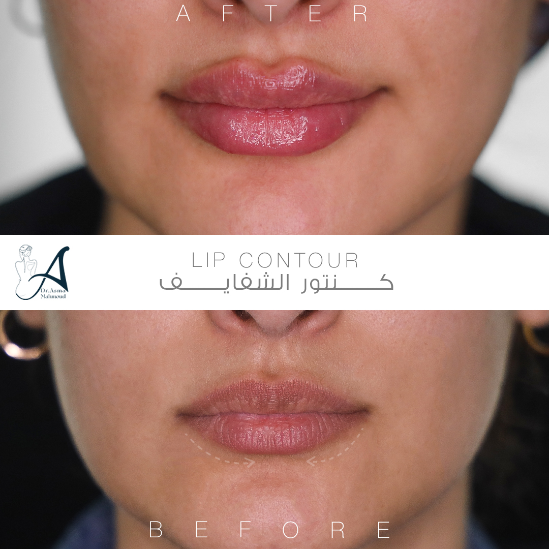 Lip Contoure