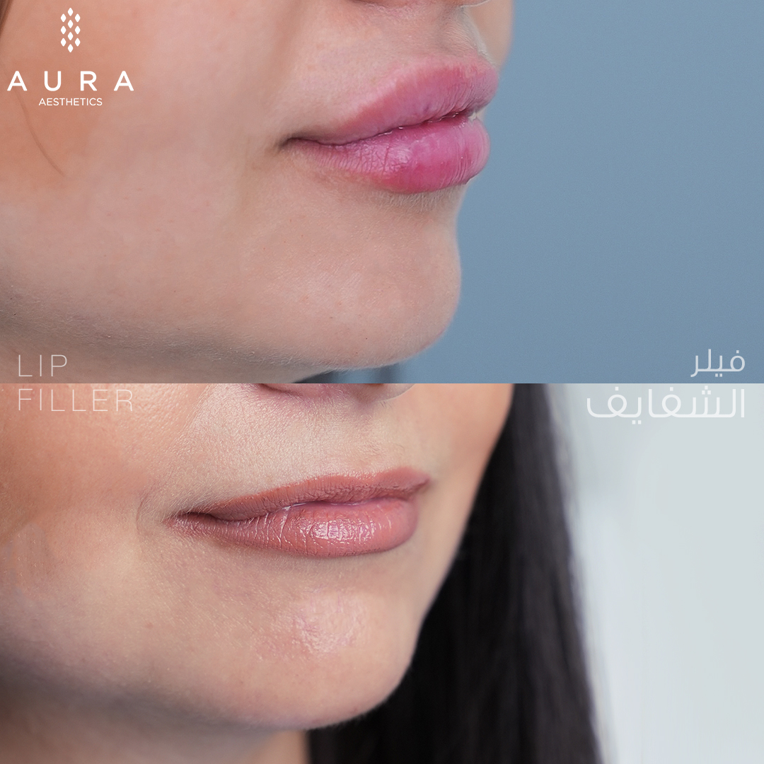 Lip Filler Side