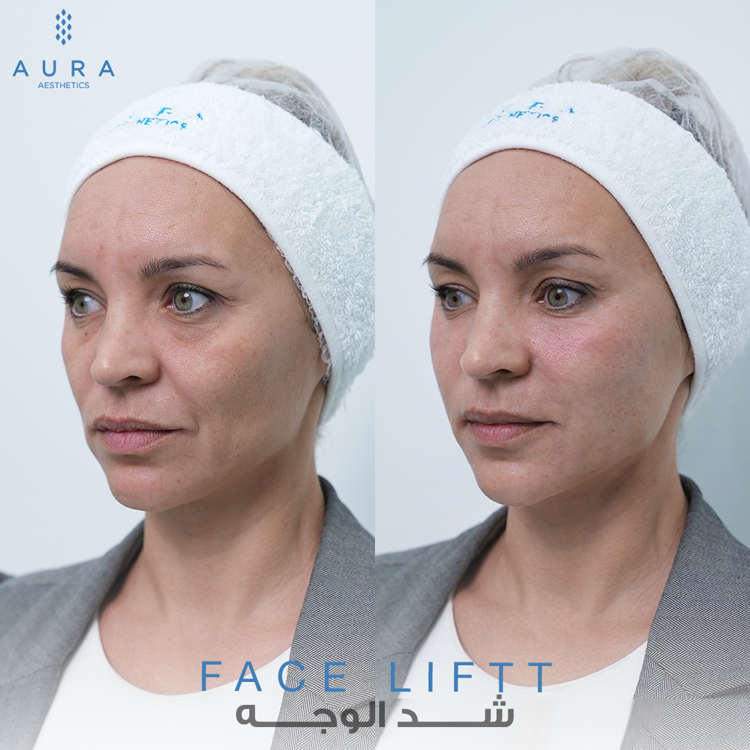 Face Lift Angle