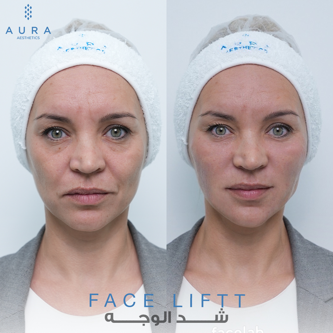 Face Lift Front