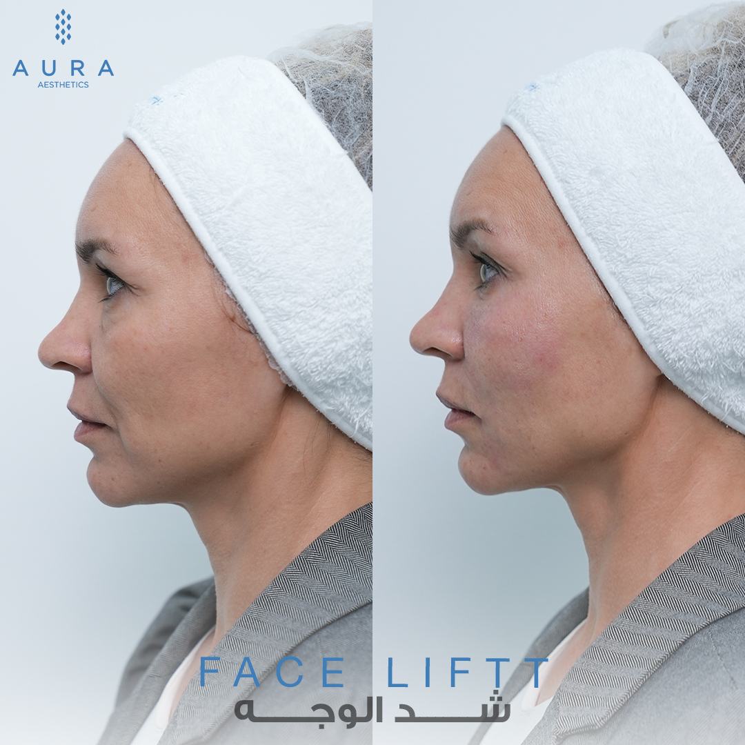 Face Lift Side