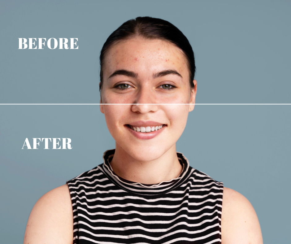 Before and After microneedling treatment