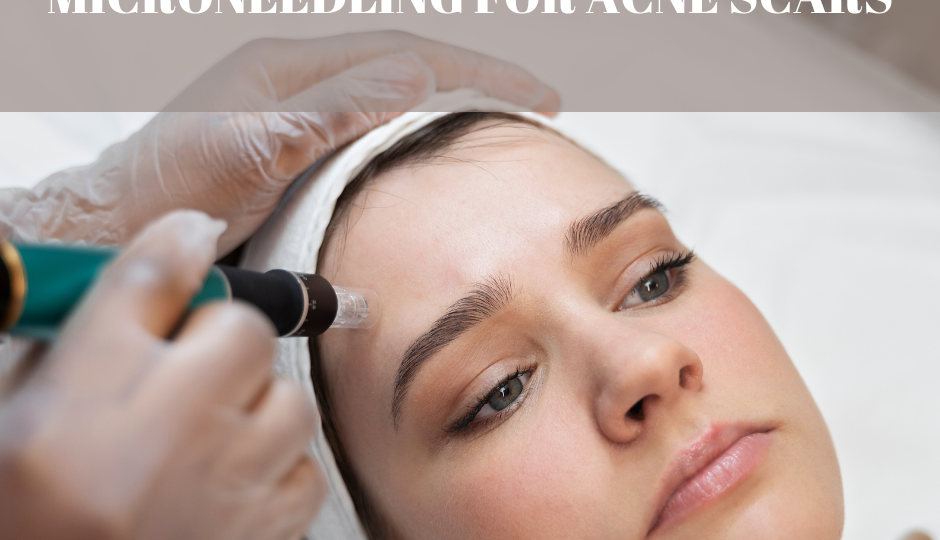 Microneedling for acne scars