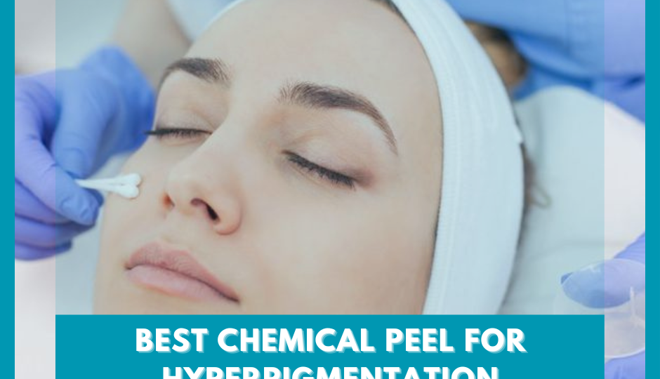 Best Chemical Peel for Hyperpigmentation - Feature